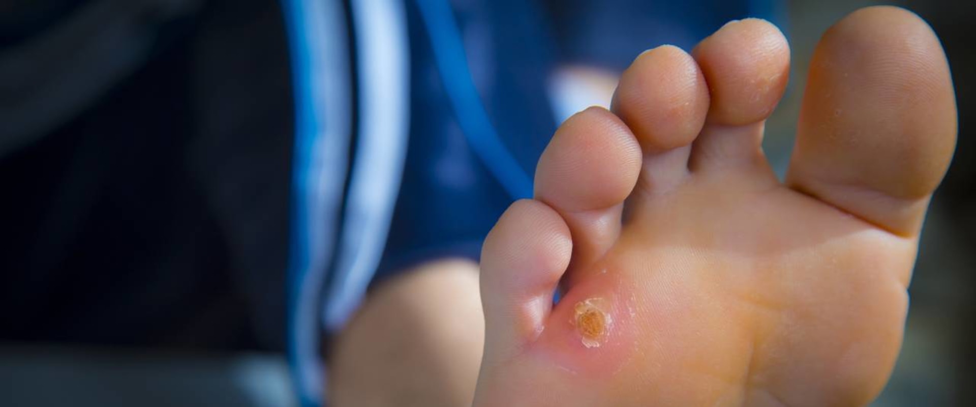 Know the Signs: The Difference Between Plantar Wart vs Corn and How to Treat Each Properly