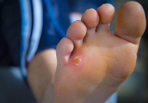 Know the Signs: The Difference Between Plantar Wart vs Corn and How to Treat Each Properly
