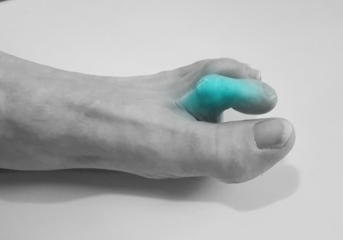 Your Feet May Be Telling You Something: Causes of Claw Toe Deformity